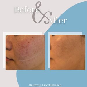 Huidzorg Laserklinieken Eindhoven- Best image 4